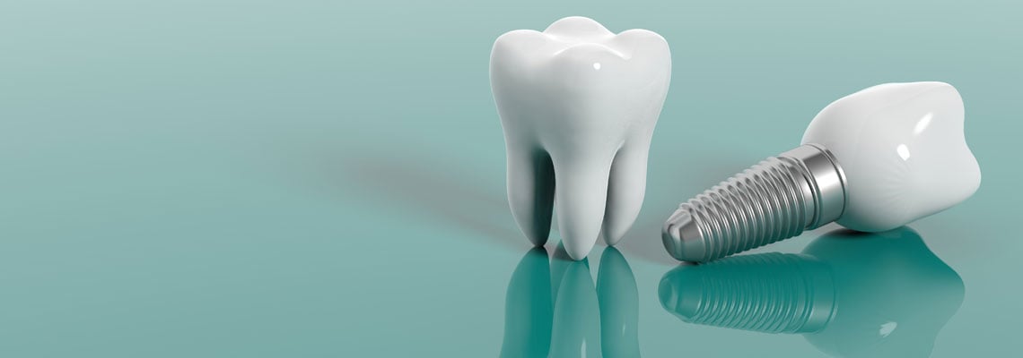 Prix d'un implant dentaire